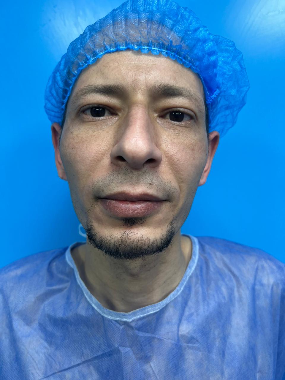 تجميل الأنف (Rhinoplasty) - بعد