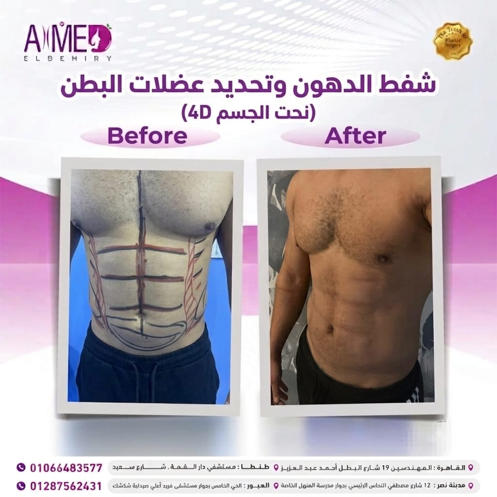 تحديد عضلات البطن وعمل Six Packs - قبل وبعد