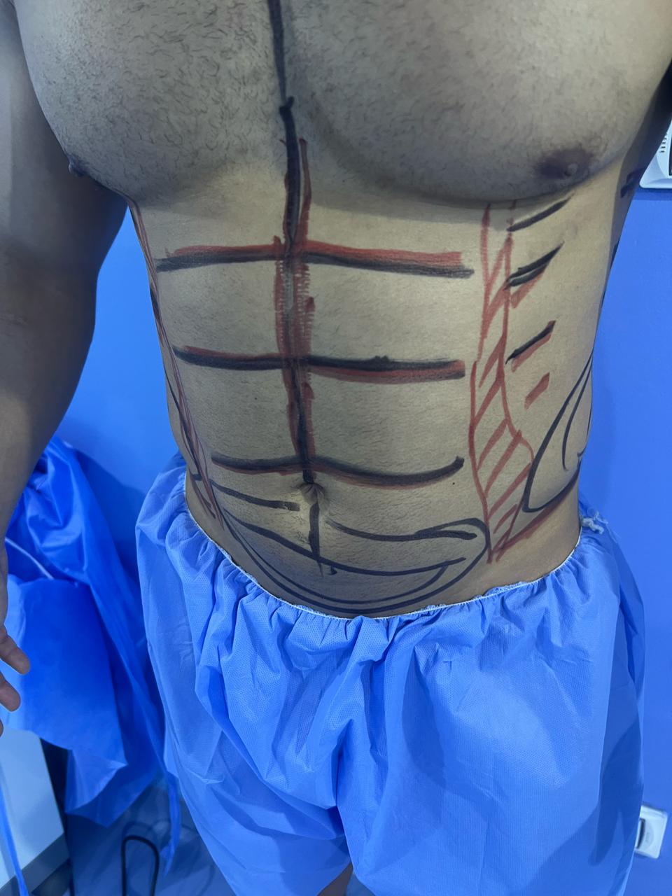 نحت دهون البطن وإظهار الـ Six Packs - قبل