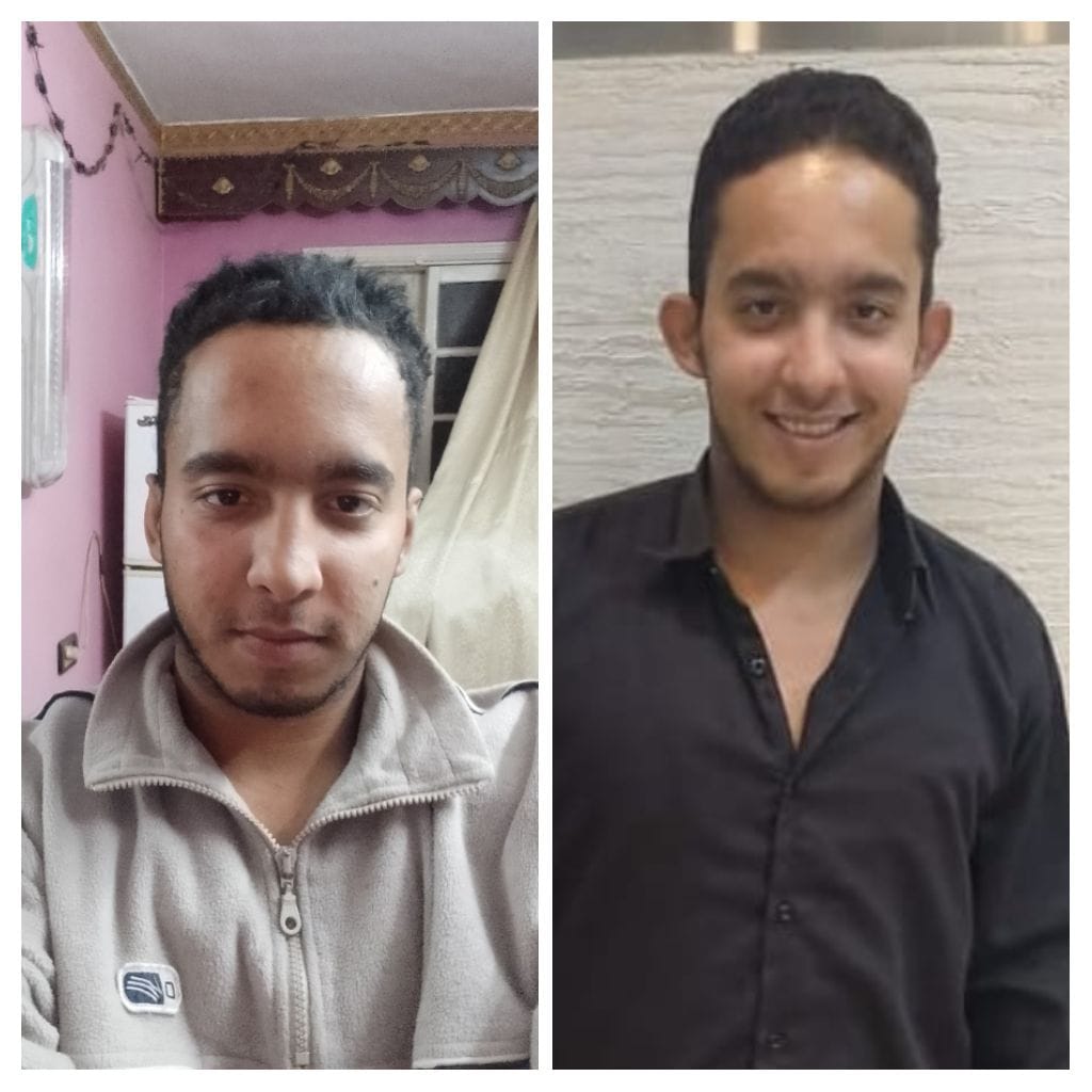تصحيح الأذن البارزة - قبل وبعد
