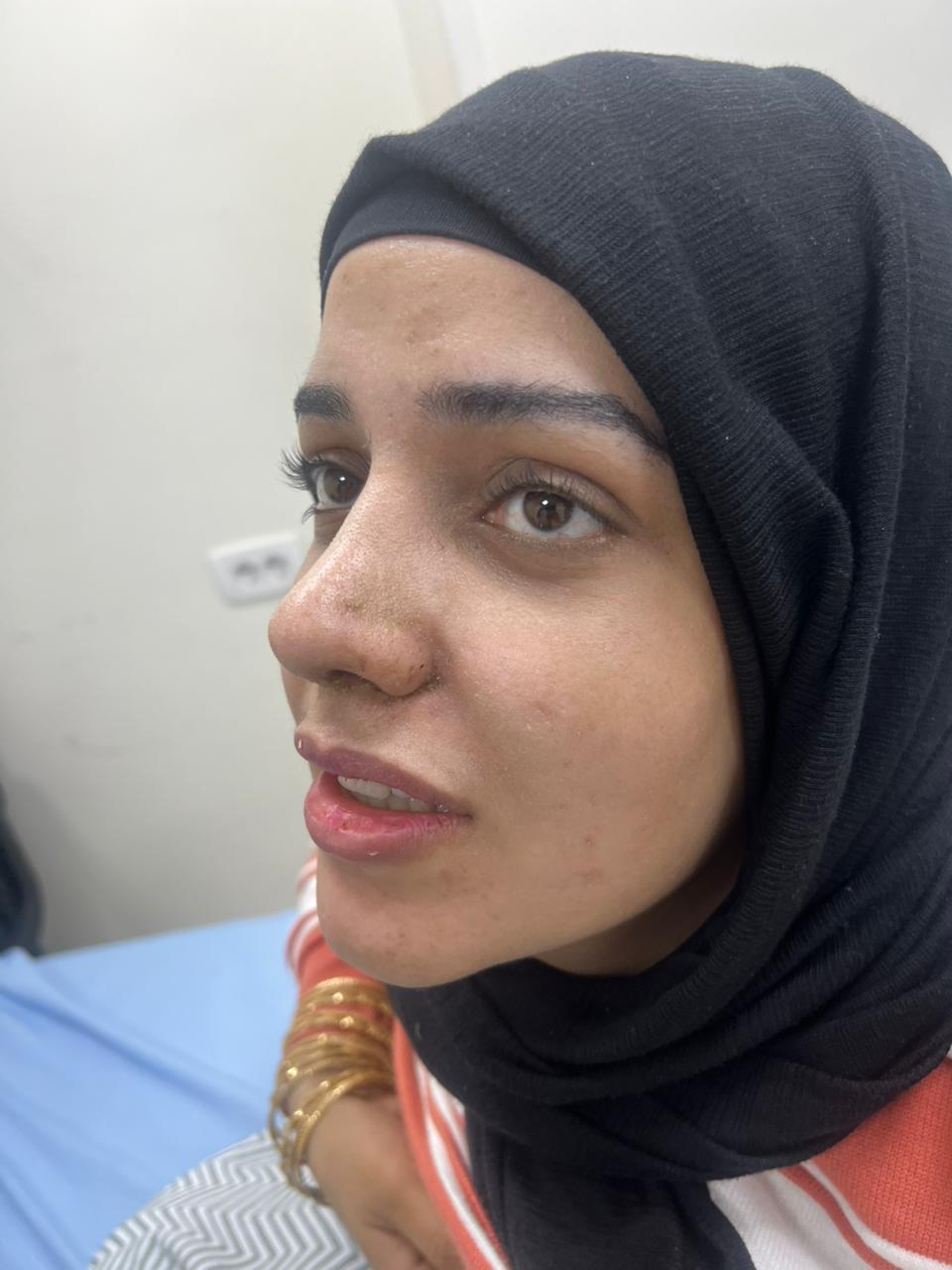 تصغير الأنف - بعد