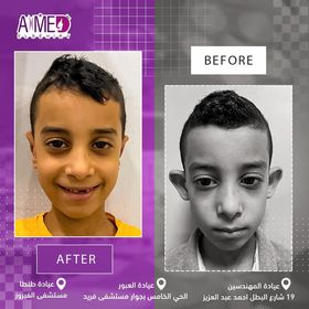 تصحيح الأذن البارزة — حالة ٤ - قبل وبعد