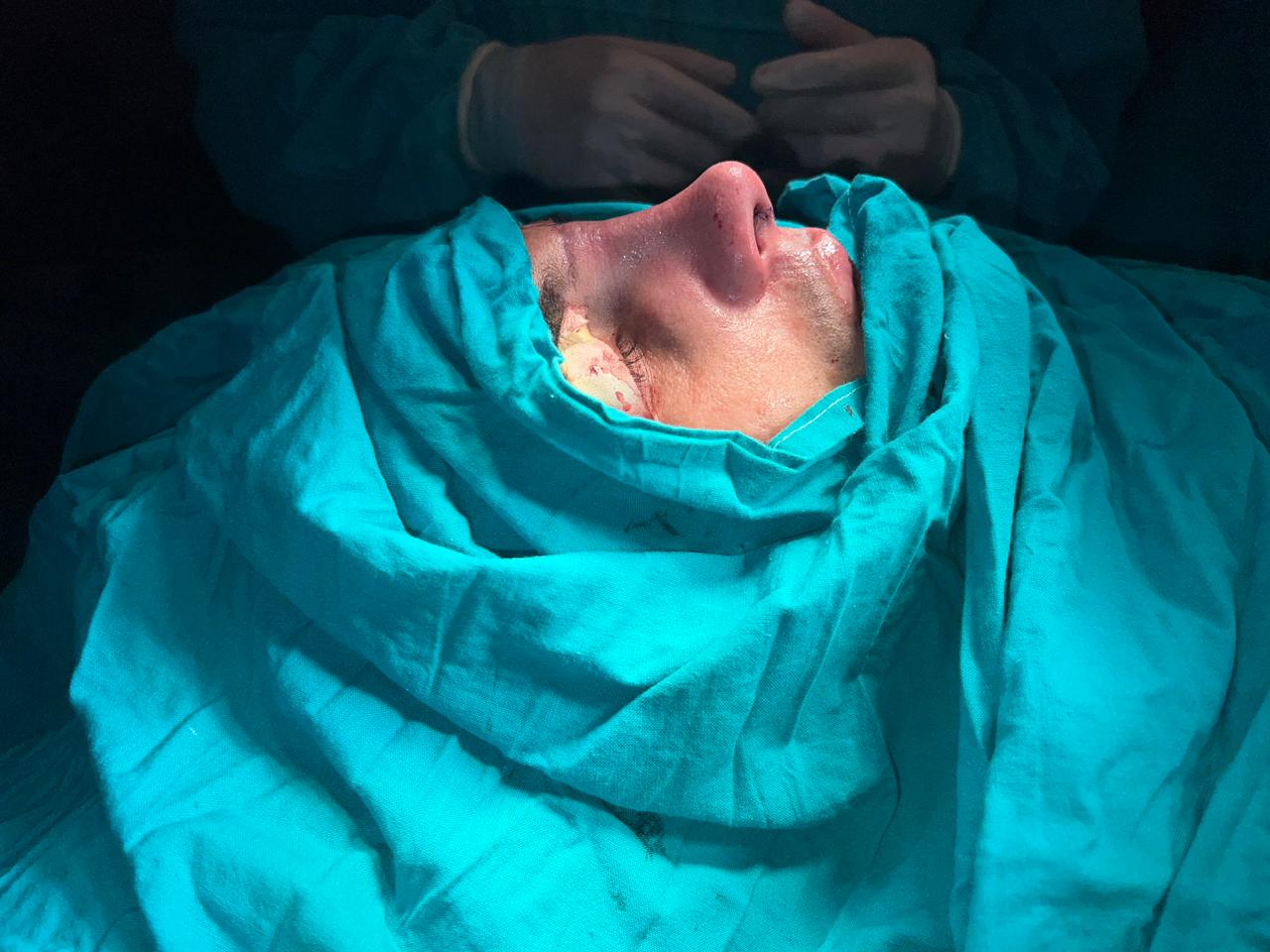 تجميل الأنف (Rhinoplasty) - أثناء الجراحة